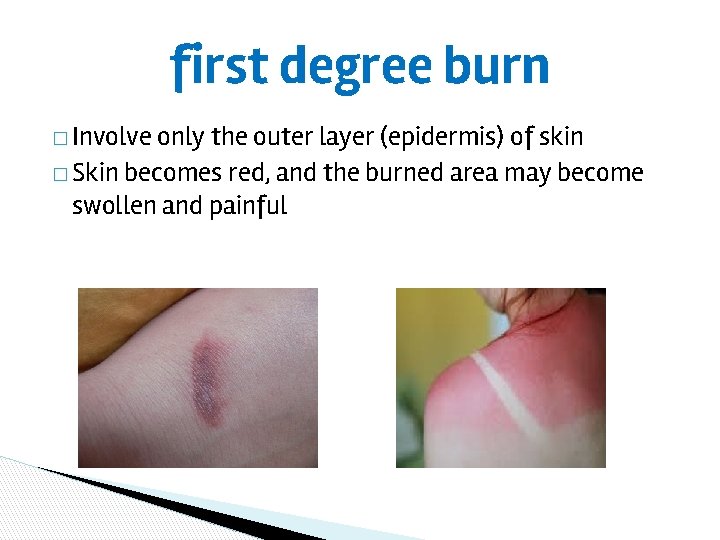 first degree burn � Involve only the outer layer (epidermis) of skin � Skin