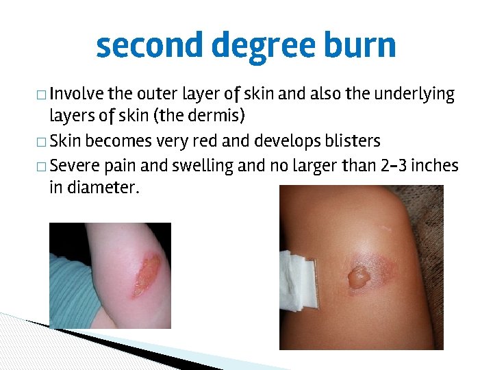 second degree burn � Involve the outer layer of skin and also the underlying