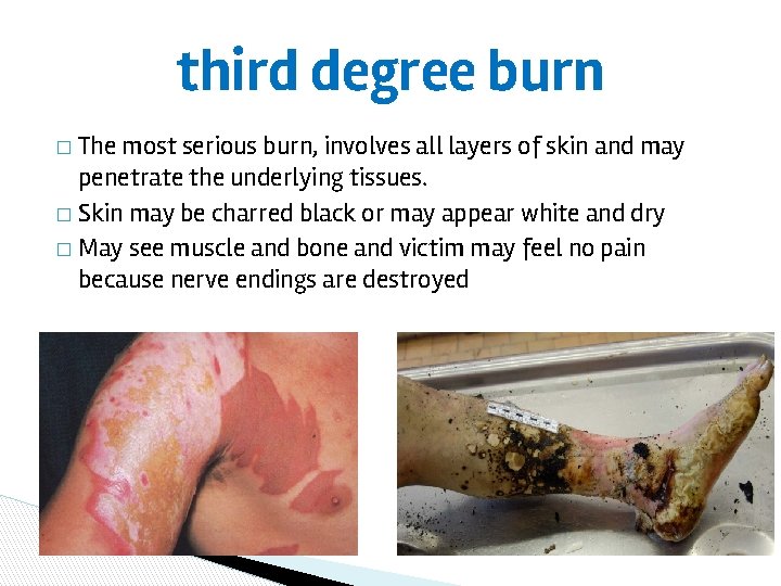 third degree burn � The most serious burn, involves all layers of skin and