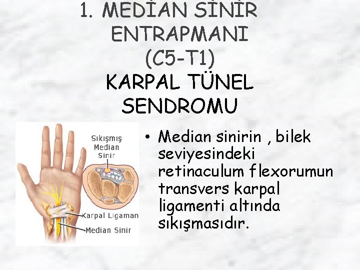 1. MEDİAN SİNİR ENTRAPMANI (C 5 -T 1) KARPAL TÜNEL SENDROMU • Median sinirin