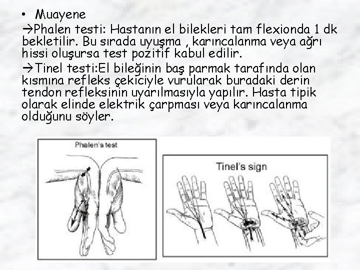  • Muayene Phalen testi: Hastanın el bilekleri tam flexionda 1 dk bekletilir. Bu