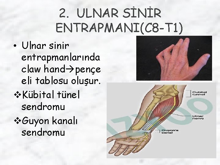 2. ULNAR SİNİR ENTRAPMANI(C 8 -T 1) • Ulnar sinir entrapmanlarında claw hand pençe