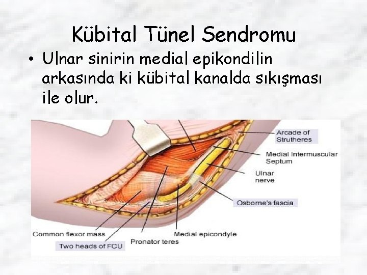 Kübital Tünel Sendromu • Ulnar sinirin medial epikondilin arkasında ki kübital kanalda sıkışması ile