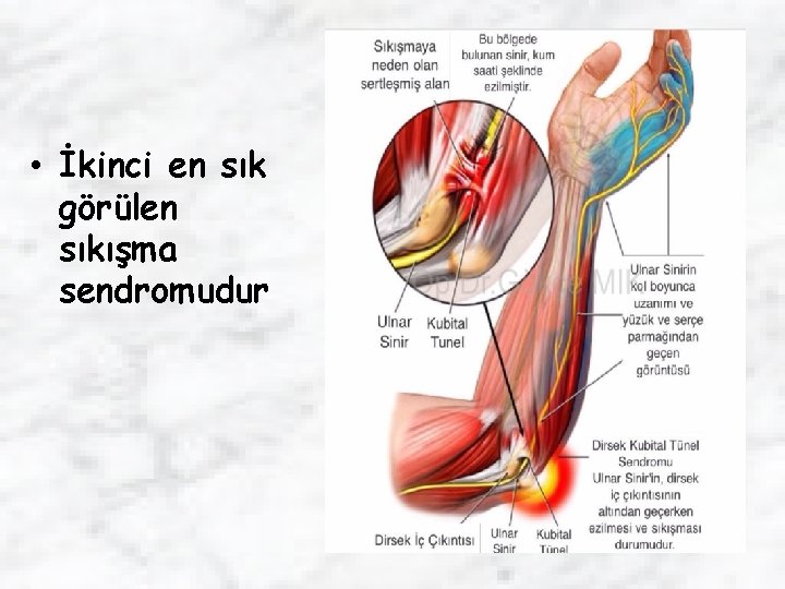  • İkinci en sık görülen sıkışma sendromudur 