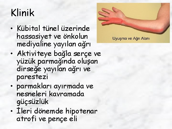 Klinik • Kübital tünel üzerinde hassasiyet ve önkolun mediyaline yayılan ağrı • Aktiviteye bağla