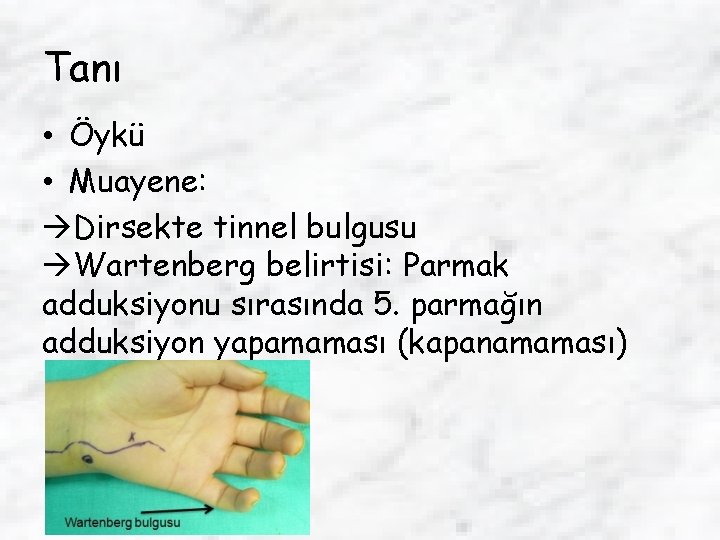 Tanı • Öykü • Muayene: Dirsekte tinnel bulgusu Wartenberg belirtisi: Parmak adduksiyonu sırasında 5.