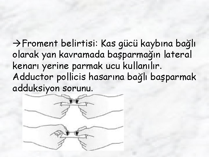  Froment belirtisi: Kas gücü kaybına bağlı olarak yan kavramada başparmağın lateral kenarı yerine