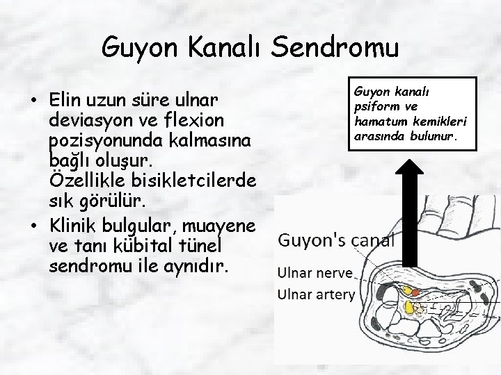 Guyon Kanalı Sendromu • Elin uzun süre ulnar deviasyon ve flexion pozisyonunda kalmasına bağlı