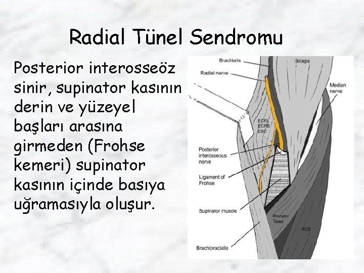 Radial Tünel Sendromu Posterior interosseöz sinir, supinator kasının derin ve yüzeyel başları arasına girmeden