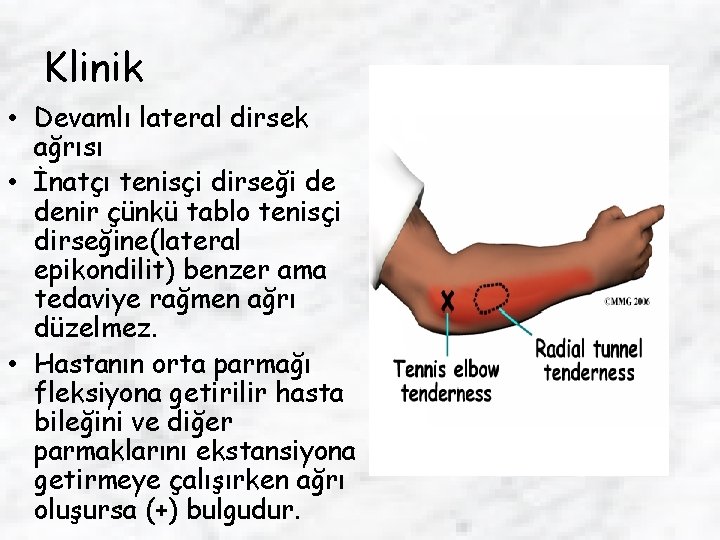 Klinik • Devamlı lateral dirsek ağrısı • İnatçı tenisçi dirseği de denir çünkü tablo