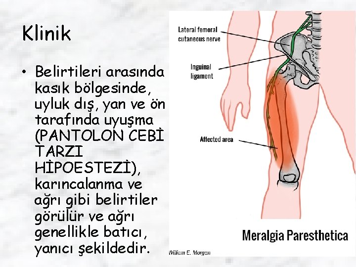 Klinik • Belirtileri arasında kasık bölgesinde, uyluk dış, yan ve ön tarafında uyuşma (PANTOLON