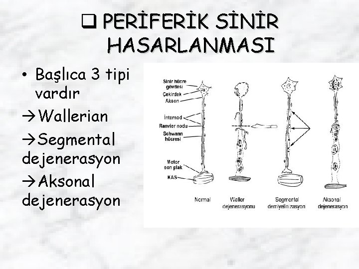 q PERİFERİK SİNİR HASARLANMASI • Başlıca 3 tipi vardır Wallerian Segmental dejenerasyon Aksonal dejenerasyon