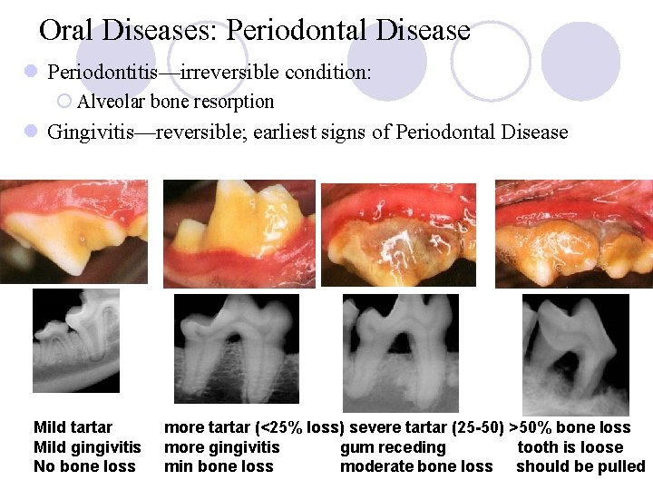Oral Diseases: Periodontal Disease l Periodontitis—irreversible condition: ¡ Alveolar bone resorption l Gingivitis—reversible; earliest