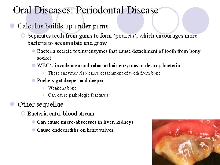 Oral Diseases: Periodontal Disease l Calculus builds up under gums ¡ Separates teeth from