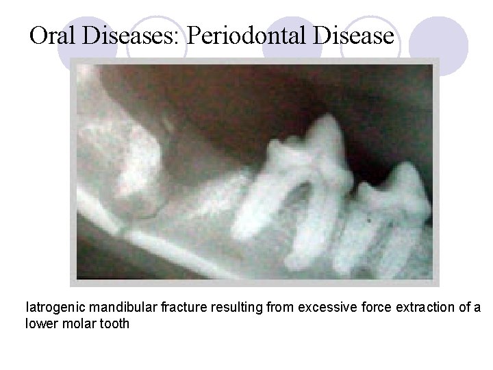 Oral Diseases: Periodontal Disease Iatrogenic mandibular fracture resulting from excessive force extraction of a