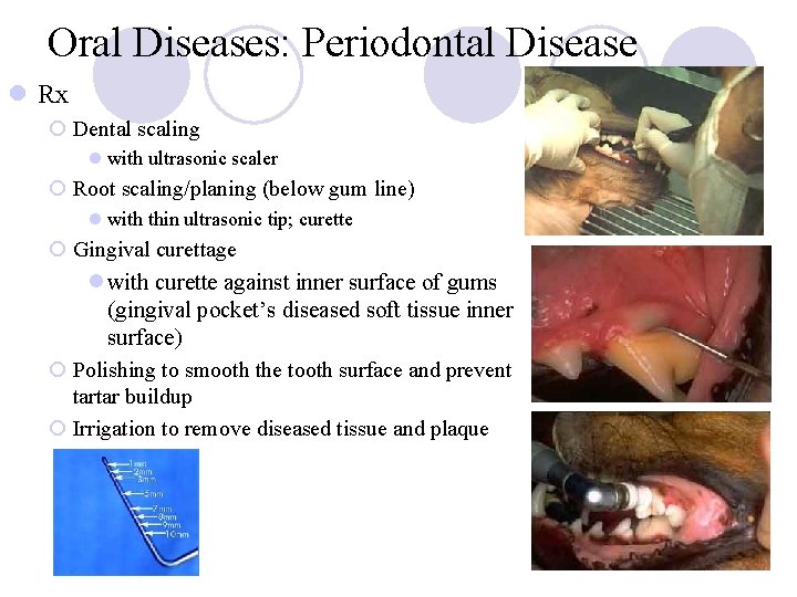 Oral Diseases: Periodontal Disease l Rx ¡ Dental scaling l with ultrasonic scaler ¡