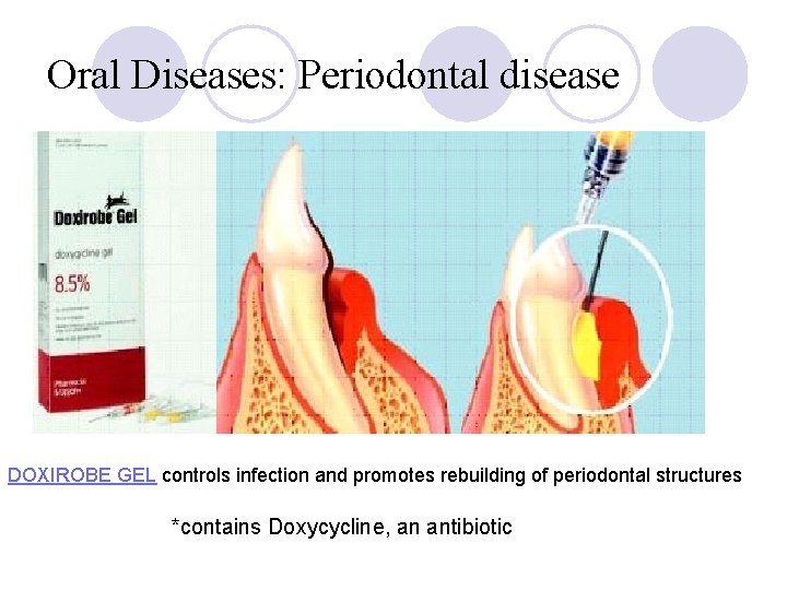 Oral Diseases: Periodontal disease DOXIROBE GEL controls infection and promotes rebuilding of periodontal structures