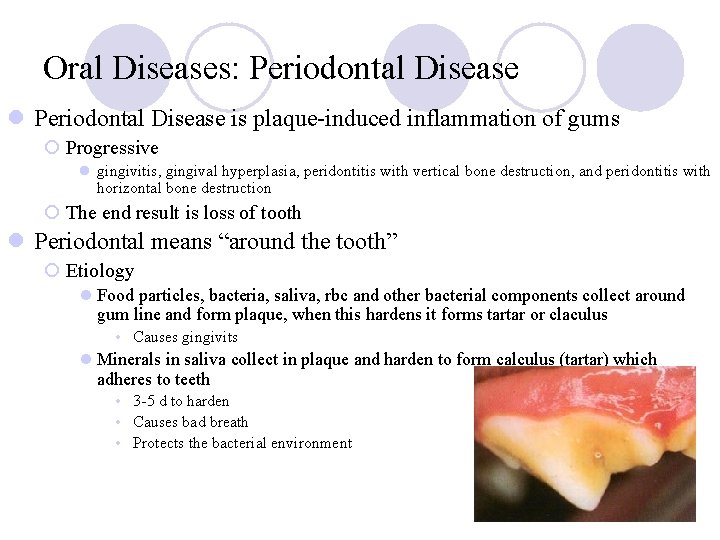 Oral Diseases: Periodontal Disease l Periodontal Disease is plaque-induced inflammation of gums ¡ Progressive