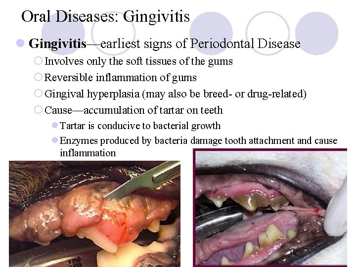 Oral Diseases: Gingivitis l Gingivitis—earliest signs of Periodontal Disease ¡ Involves only the soft