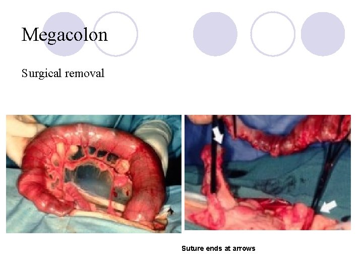 Megacolon Surgical removal Suture ends at arrows 