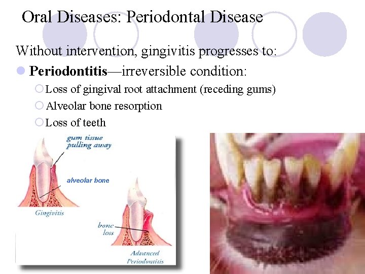 Oral Diseases: Periodontal Disease Without intervention, gingivitis progresses to: l Periodontitis—irreversible condition: ¡ Loss