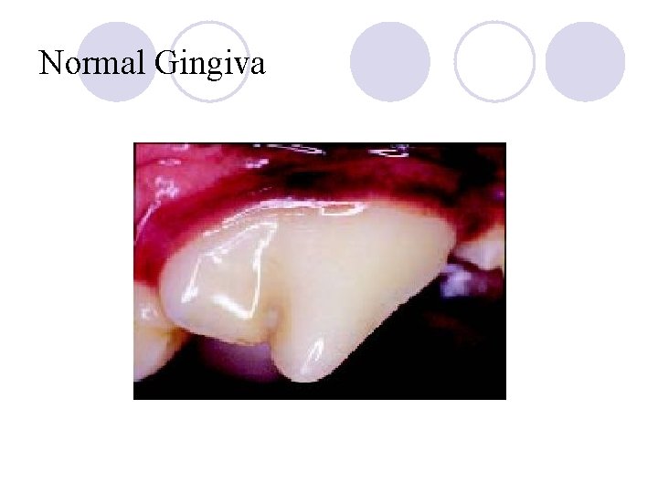 Normal Gingiva 