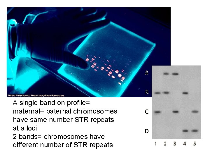 A single band on profile= maternal+ paternal chromosomes have same number STR repeats at