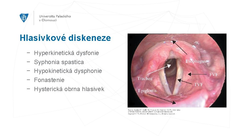 Hlasivkové diskeneze − − − Hyperkinetická dysfonie Syphonia spastica Hypokinetická dysphonie Fonastenie Hysterická obrna