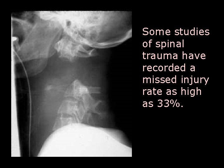 Some studies of spinal trauma have recorded a missed injury rate as high as