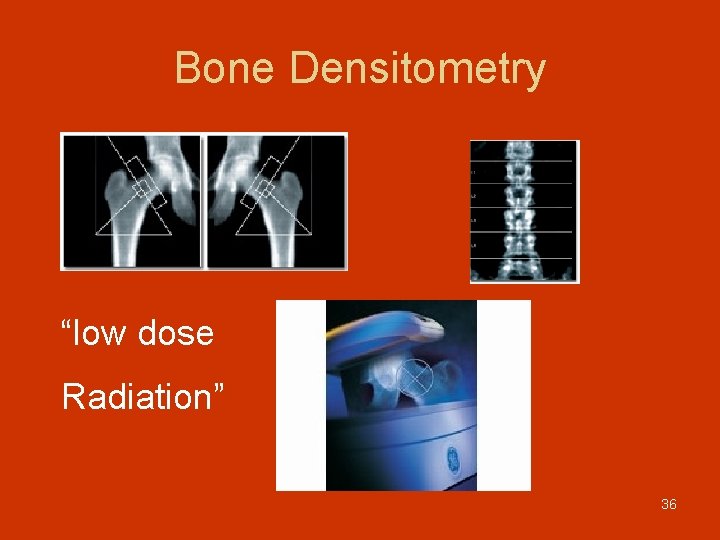 Bone Densitometry “low dose Radiation” 36 