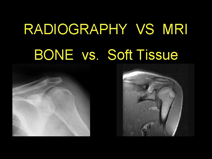 RADIOGRAPHY VS MRI BONE vs. Soft Tissue 55 