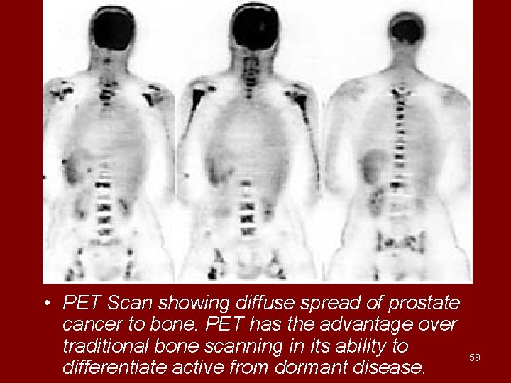  • PET Scan showing diffuse spread of prostate cancer to bone. PET has
