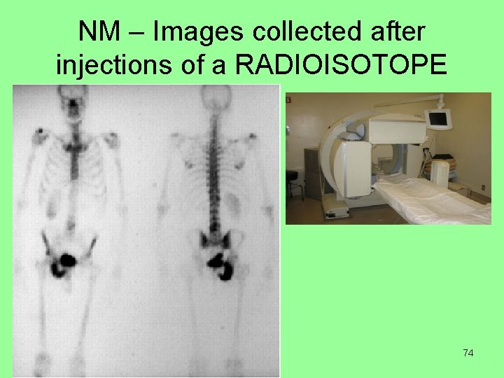 NM – Images collected after injections of a RADIOISOTOPE 74 