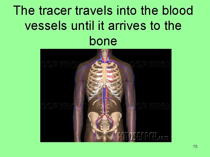 The tracer travels into the blood vessels until it arrives to the bone 75