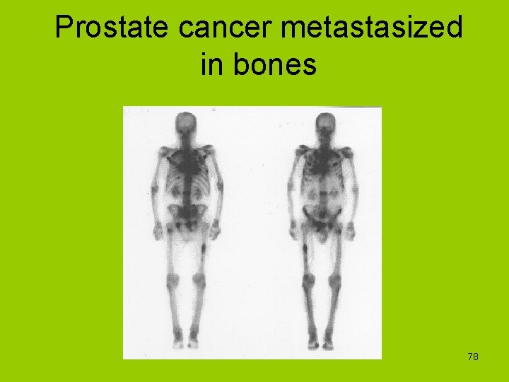 Prostate cancer metastasized in bones 78 