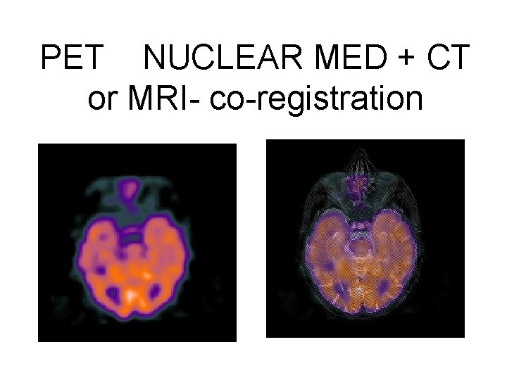 PET NUCLEAR MED + CT or MRI- co-registration 79 