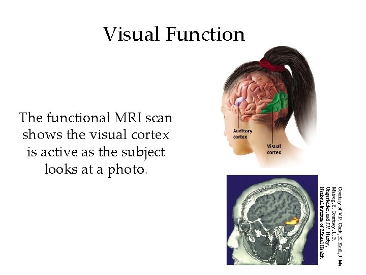 Visual Function The functional MRI scan shows the visual cortex is active as the