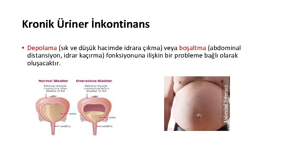 Kronik Üriner İnkontinans • Depolama (sık ve düşük hacimde idrara çıkma) veya boşaltma (abdominal