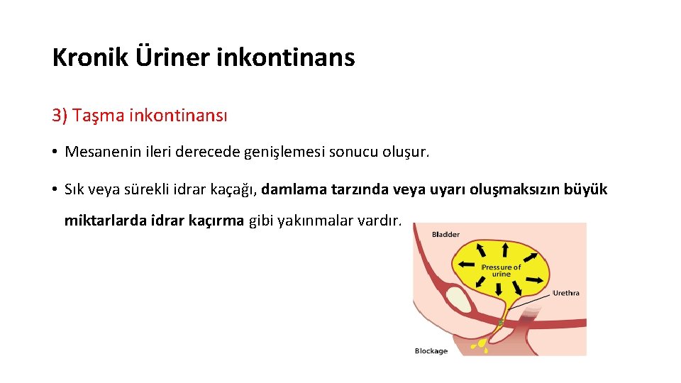 Kronik Üriner inkontinans 3) Taşma inkontinansı • Mesanenin ileri derecede genişlemesi sonucu oluşur. •