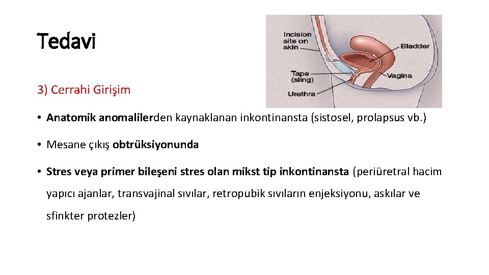 Tedavi 3) Cerrahi Girişim • Anatomik anomalilerden kaynaklanan inkontinansta (sistosel, prolapsus vb. ) •