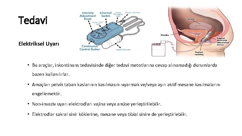 Tedavi Elektriksel Uyarı • Bu araçlar, inkontinans tedavisinde diğer tedavi metotlarına cevap alınamadığı durumlarda