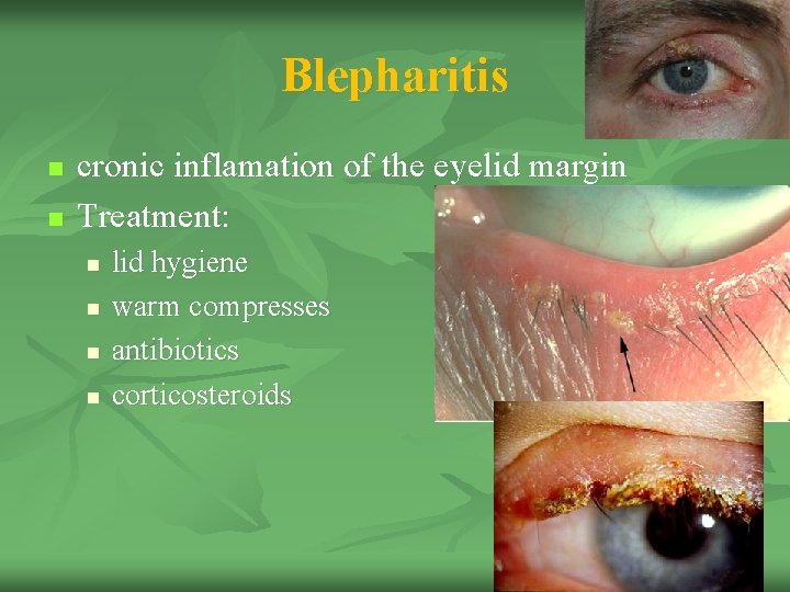 Blepharitis n n cronic inflamation of the eyelid margin Treatment: n n lid hygiene