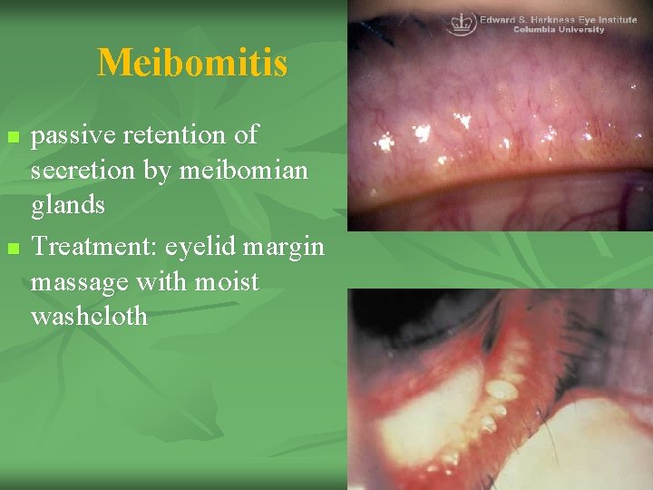 Meibomitis n n passive retention of secretion by meibomian glands Treatment: eyelid margin massage Meibomitis n n passive retention of secretion by meibomian glands Treatment: eyelid margin massage