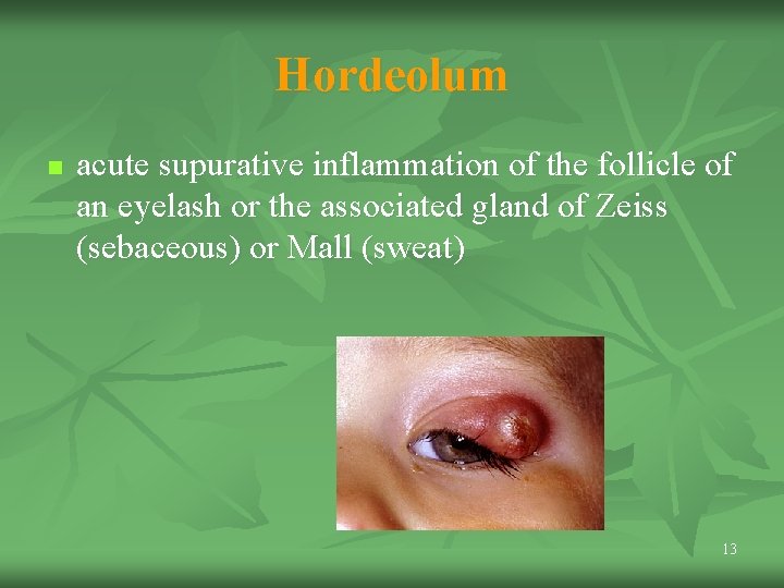 Hordeolum n acute supurative inflammation of the follicle of an eyelash or the associated Hordeolum n acute supurative inflammation of the follicle of an eyelash or the associated