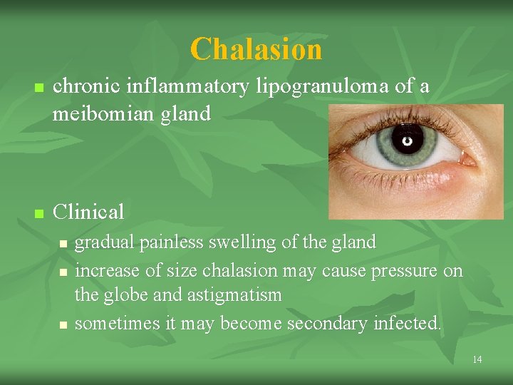 Chalasion n n chronic inflammatory lipogranuloma of a meibomian gland Clinical n n n Chalasion n n chronic inflammatory lipogranuloma of a meibomian gland Clinical n n n