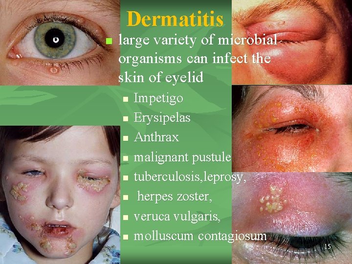 Dermatitis n large variety of microbial organisms can infect the skin of eyelid n Dermatitis n large variety of microbial organisms can infect the skin of eyelid n