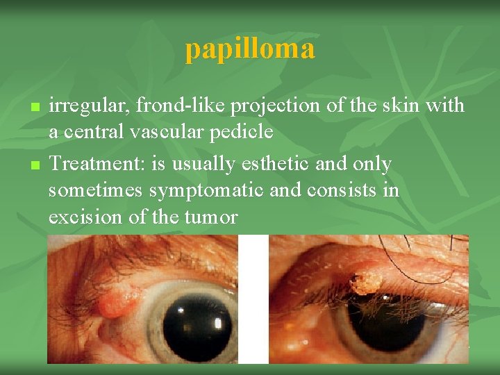 papilloma n n irregular, frond-like projection of the skin with a central vascular pedicle