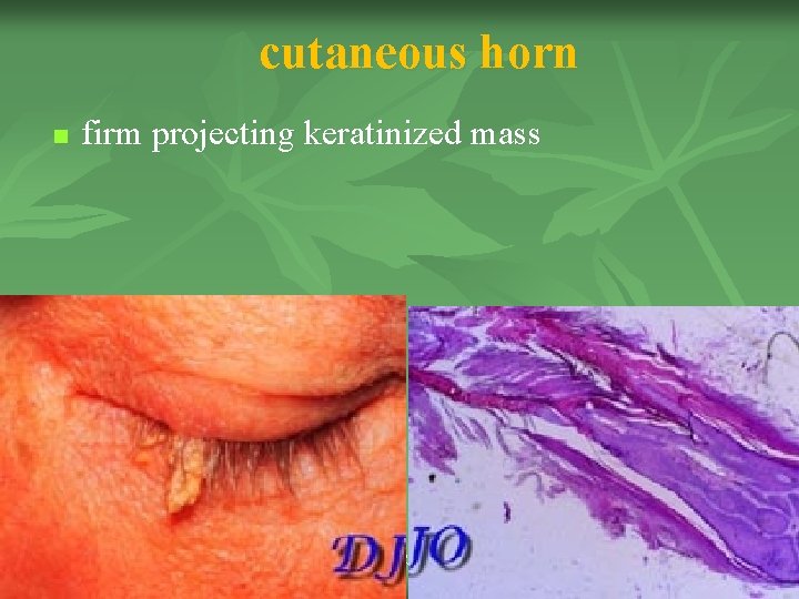 cutaneous horn n firm projecting keratinized mass LECTURER DR. RUSU VALERIU 18 