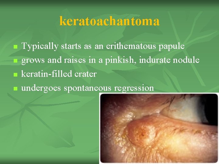 keratoachantoma n n Typically starts as an erithematous papule grows and raises in a