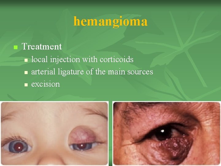 hemangioma n Treatment n n n local injection with corticoids arterial ligature of the hemangioma n Treatment n n n local injection with corticoids arterial ligature of the